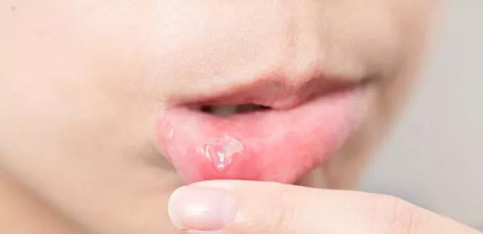 ما أسباب فطريات الفم للرضع والأطفال؟ وكيف تعالج؟