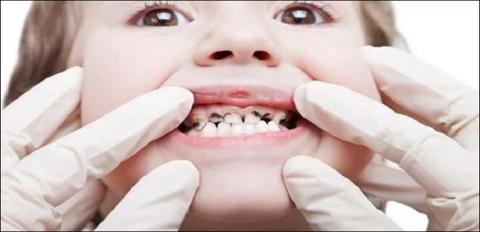 تعرف الى طرق علاج تسوس الاسنان عند الاطفال في المنزل