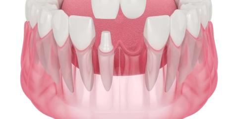 ما هي أنواع جسور الأسنان؟