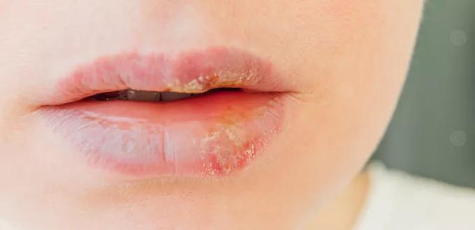 أبرز أسباب جفاف الفم