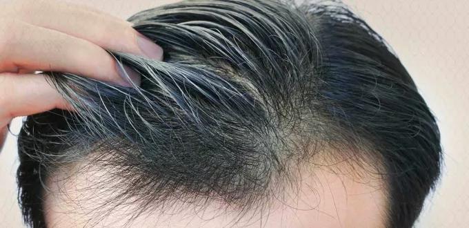 زراعة الشعر لعلاج حالات الصلع