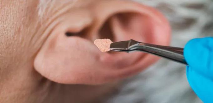 طرق علاج انسداد الأذن