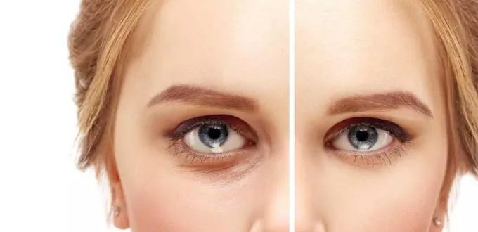 كيف يمكن علاج انتفاخ العين؟