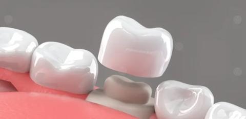 ما هي أضرار تلبيس الأسنان؟
