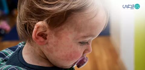 التدابير العلاجية للأكزيما التي تصيب الأطفال