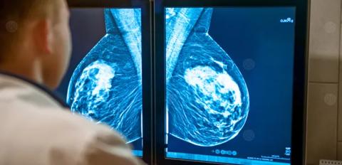 سرطان الثدي المرحلة الثالثة وعلاجه