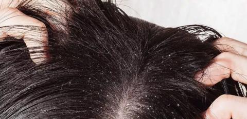 وصفات علاج قشرة الشعر بالمنزل