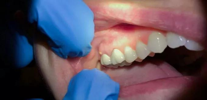 كيف يمكن علاج خراج الأسنان؟