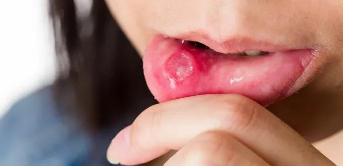 3 طرق لعلاج تقرحات الفم