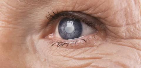 ما هي أعراض الماء الأبيض في العين؟